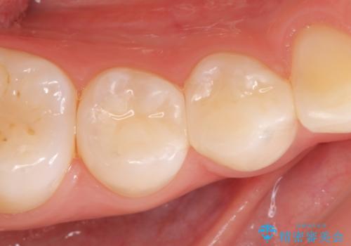 セラミックインレー　しみる歯の審美的治療の症例 治療後