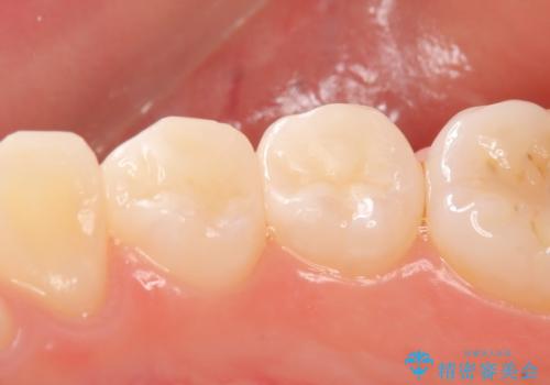 セラミックインレー しみる歯の審美的治療の治療後