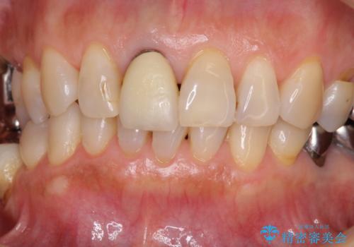 金属を全てセラミックに メタルフリー治療の治療前