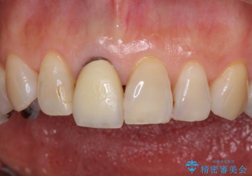 金属を全てセラミックに メタルフリー治療の治療前