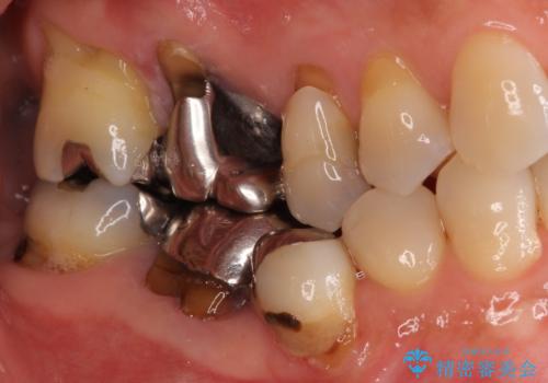 金属を全てセラミックに メタルフリー治療の治療前