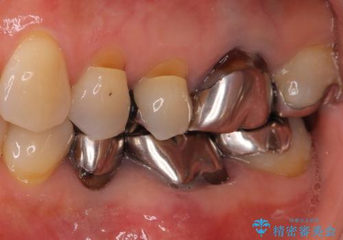 金属を全てセラミックに メタルフリー治療の治療前