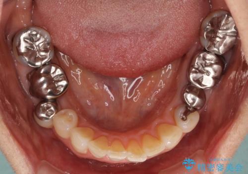 金属を全てセラミックに メタルフリー治療の治療前