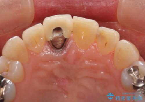 金属を全てセラミックに メタルフリー治療の治療前