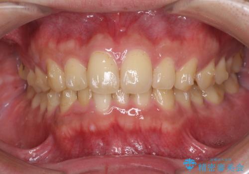 深い咬み合わせと前歯のデコボコの改善　インビザラインによる矯正治療の治療中