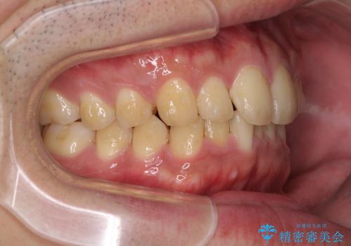 深い咬み合わせと前歯のデコボコの改善 インビザラインによる矯正治療の治療中