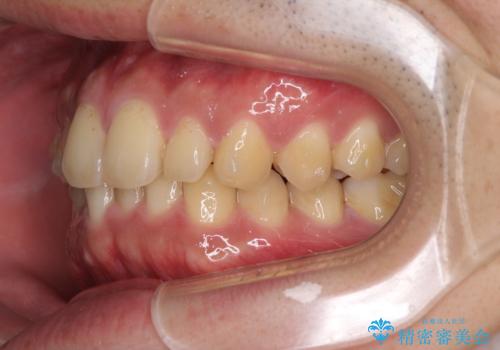 深い咬み合わせと前歯のデコボコの改善 インビザラインによる矯正治療の治療中