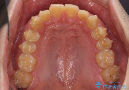 深い咬み合わせと前歯のデコボコの改善 インビザラインによる矯正治療の治療中