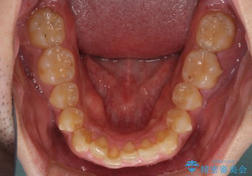 深い咬み合わせと前歯のデコボコの改善 インビザラインによる矯正治療の治療中