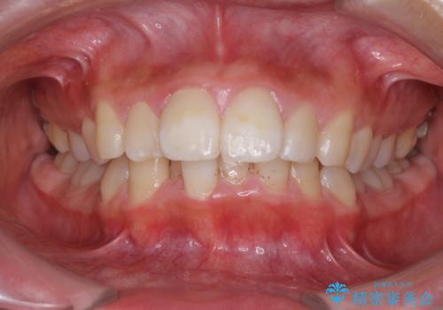 口が閉じられない 抜歯矯正で口元をスッキリとの治療前