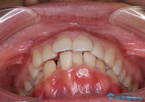 口が閉じられない 抜歯矯正で口元をスッキリとの治療前