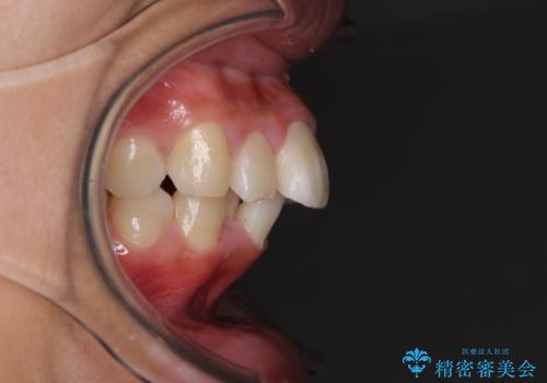 口が閉じられない 抜歯矯正で口元をスッキリとの治療前