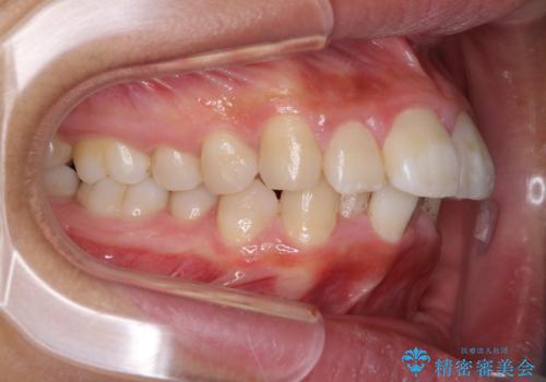 口が閉じられない 抜歯矯正で口元をスッキリとの症例 治療前