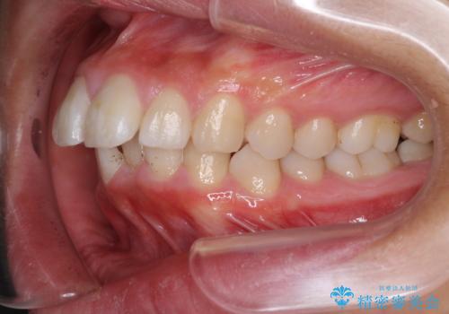 口が閉じられない 抜歯矯正で口元をスッキリとの治療前