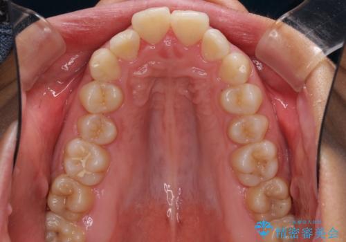 口が閉じられない 抜歯矯正で口元をスッキリとの治療前