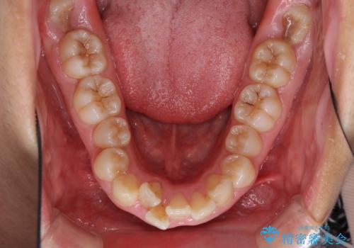 口が閉じられない 抜歯矯正で口元をスッキリとの治療前