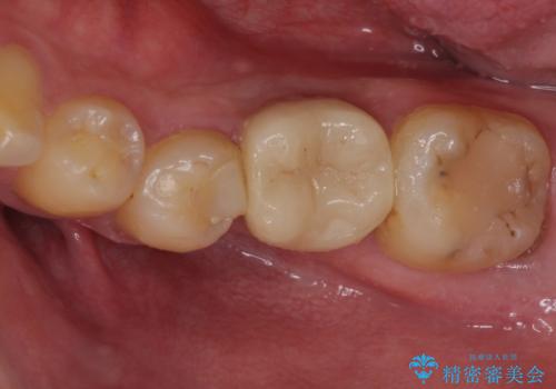 セラミッククラウンによる奥歯のむし歯治療の症例 治療前