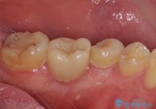 セラミッククラウンによる奥歯のむし歯治療の治療前