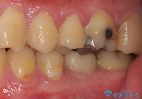 セラミッククラウンによる奥歯のむし歯治療の治療前