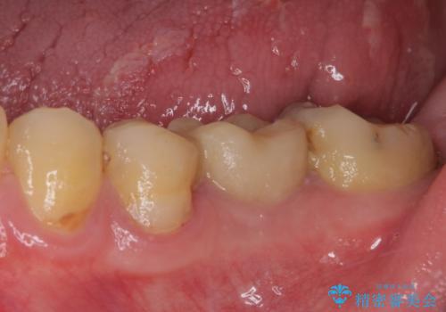 セラミッククラウンによる奥歯のむし歯治療の治療前