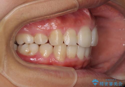 口が閉じられない 抜歯矯正で口元をスッキリとの症例 治療後