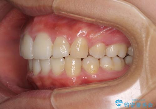 口が閉じられない 抜歯矯正で口元をスッキリとの治療後