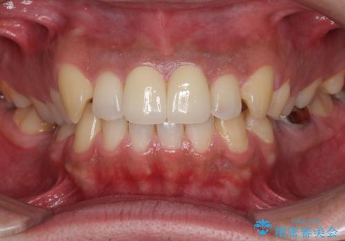 捻れた出っ歯の前歯　オールセラミッククラウンによる審美治療の治療後