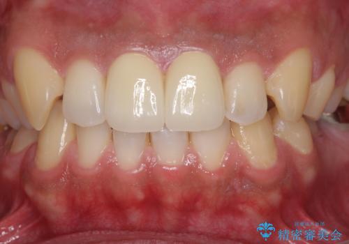 捻れた出っ歯の前歯 オールセラミッククラウンによる審美治療の治療後