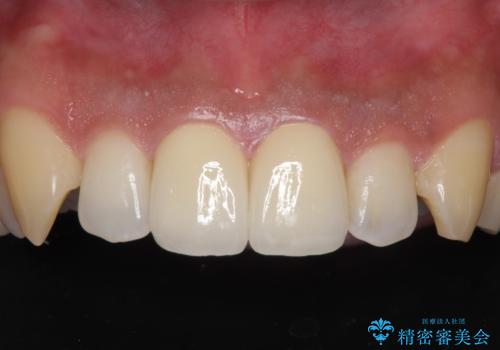 捻れた出っ歯の前歯 オールセラミッククラウンによる審美治療の症例 治療後