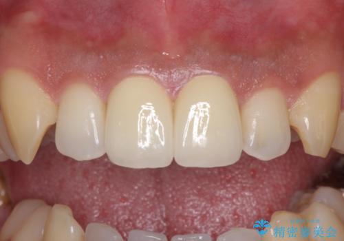捻れた出っ歯の前歯 オールセラミッククラウンによる審美治療の治療後