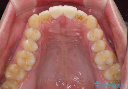 捻れた出っ歯の前歯 オールセラミッククラウンによる審美治療の治療後