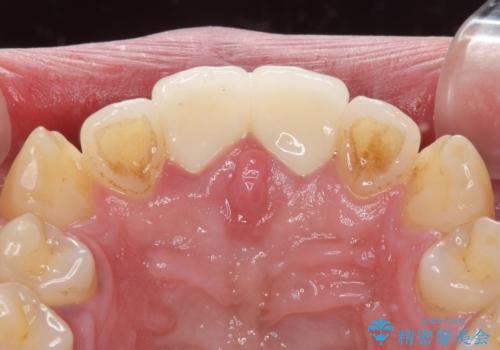 捻れた出っ歯の前歯 オールセラミッククラウンによる審美治療の治療後