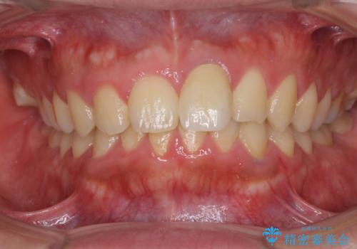 ぶつけた前歯 変色歯をオールセラミッククラウンにの治療後