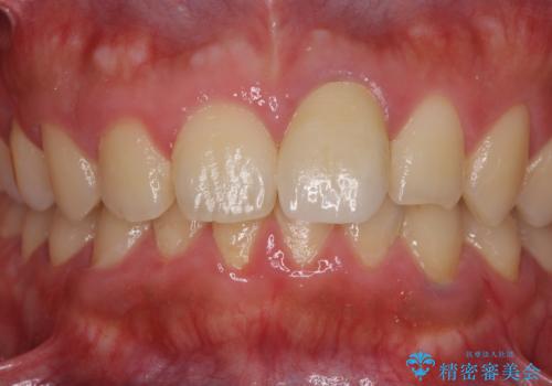 ぶつけた前歯 変色歯をオールセラミッククラウンにの治療後