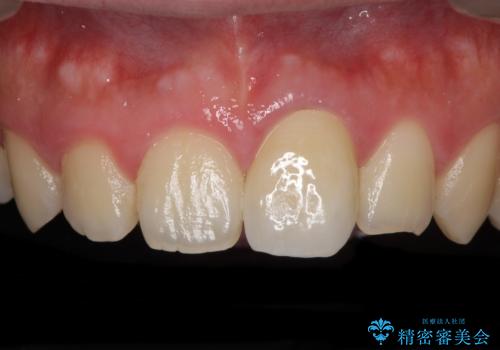 ぶつけた前歯 変色歯をオールセラミッククラウンにの症例 治療後