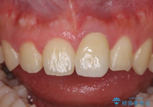 ぶつけた前歯 変色歯をオールセラミッククラウンにの治療後
