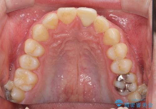 ぶつけた前歯 変色歯をオールセラミッククラウンにの治療後