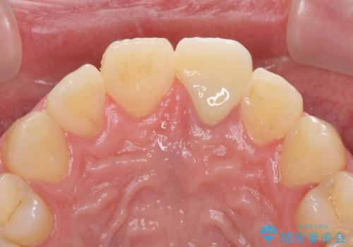 ぶつけた前歯 変色歯をオールセラミッククラウンにの治療後