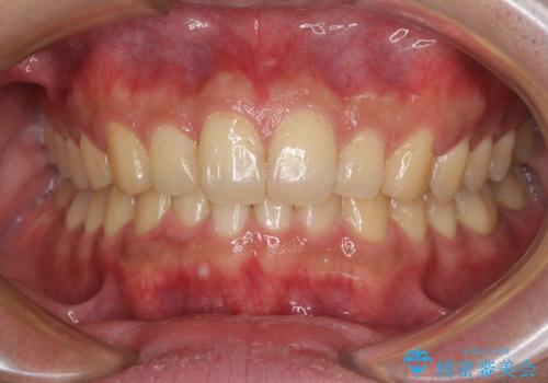 深い咬み合わせと前歯のデコボコの改善 インビザラインによる矯正治療の症例 治療後