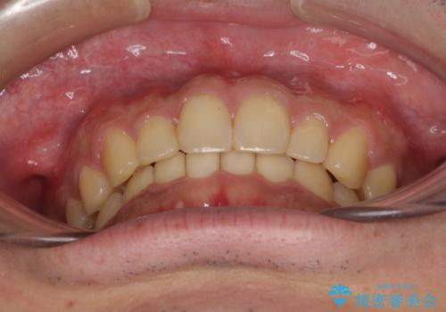 深い咬み合わせと前歯のデコボコの改善　インビザラインによる矯正治療の治療後