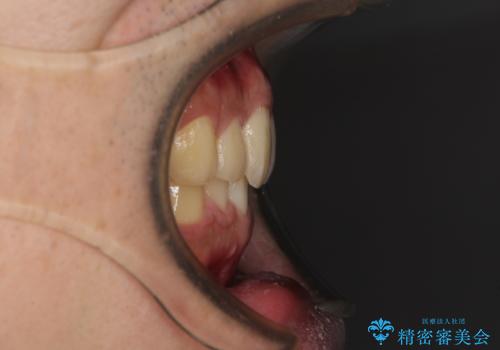 深い咬み合わせと前歯のデコボコの改善 インビザラインによる矯正治療の治療後