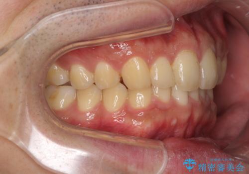 深い咬み合わせと前歯のデコボコの改善 インビザラインによる矯正治療の治療後