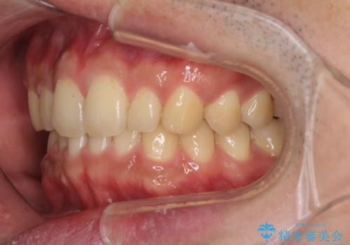 深い咬み合わせと前歯のデコボコの改善 インビザラインによる矯正治療の治療後