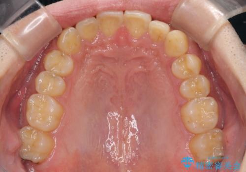 深い咬み合わせと前歯のデコボコの改善 インビザラインによる矯正治療の治療後
