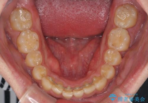 深い咬み合わせと前歯のデコボコの改善　インビザラインによる矯正治療の治療後