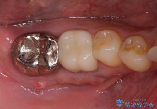 強い咬み合わせで割れてしまった奥歯 インプラントによる咬合回復の症例 治療前