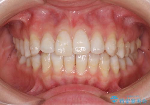 話しにくいオープンバイト インビザラインによる矯正治療の治療中