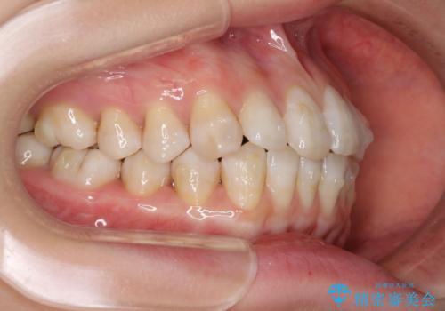話しにくいオープンバイト インビザラインによる矯正治療の治療中