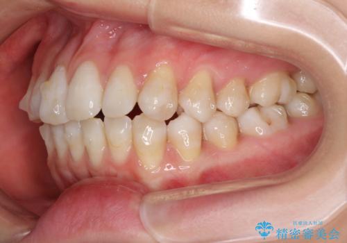 話しにくいオープンバイト インビザラインによる矯正治療の治療中