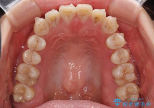 話しにくいオープンバイト インビザラインによる矯正治療の治療中